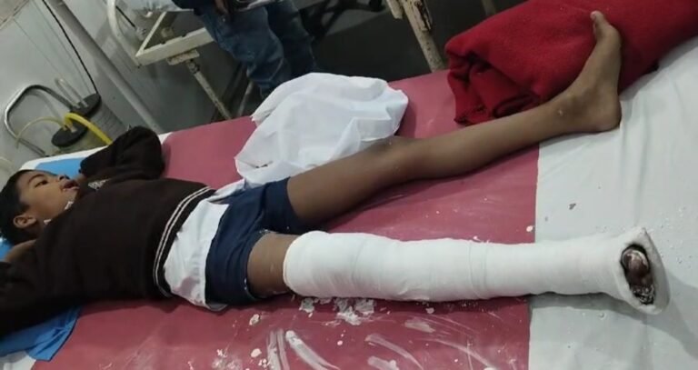 Singrauli - स्कूल जा रहे हैं बच्चे को पिकअप वाहन ने मारी टक्कर, बच्चे का दाहिना पैर टूटा